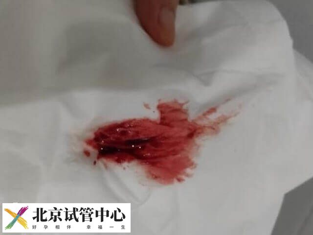 宫外孕早期有哪些征兆