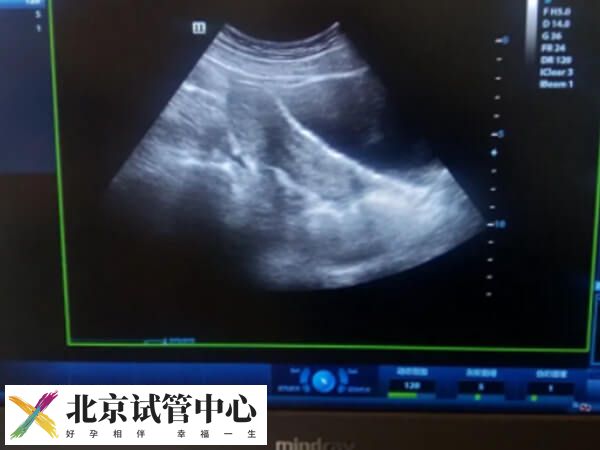 哪些情况下会取消鲜胚移植(图1) 哪些情况下会取消鲜胚移植(图1)