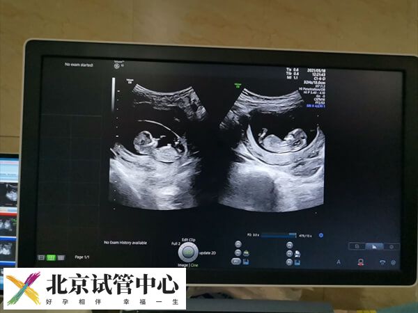 移植两个胚胎是不是双胞胎(图1) 移植两个胚胎是不是双胞胎(图1)