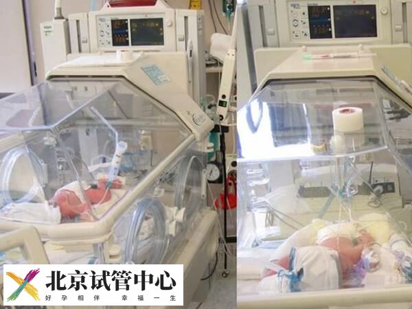 移植两个胚胎是不是双胞胎(图2) 移植两个胚胎是不是双胞胎(图2)