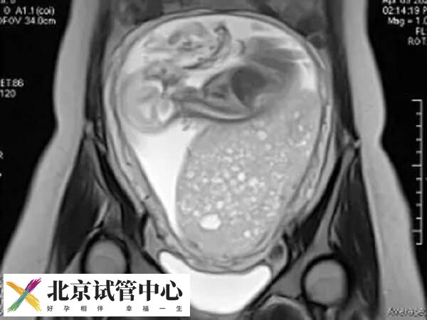 试管出现葡萄胎是什么原因(图1) 试管出现葡萄胎是什么原因(图1)